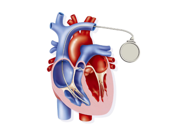 急性心肌炎可能會(huì)導(dǎo)致猝