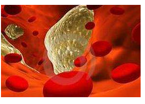 動脈硬化的早期危險信號